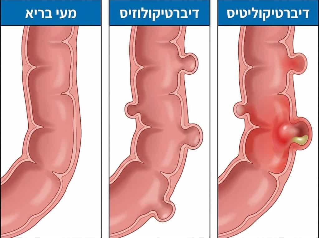 אישה מתמודדת עם דיברטיקוליטיס במבט אופטימי המביע תקווה להחלמה ושיפור איכות החיים.