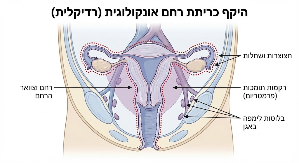 תרשים רפואי הממחיש את היקף כריתת רחם אונקולוגית (רדיקלית): הצגת הרחם, צוואר הרחם, החצוצרות, השחלות, הרקמות התומכות ובלוטות הלימפה באגן.