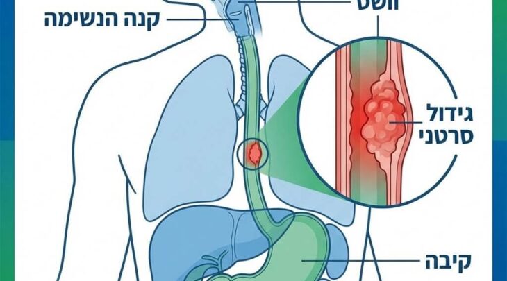 מערכת העיכול העליונה המציגה את הוושט, קנה הנשימה והקיבה, עם הגדלה המראה גידול סרטני בדופן הוושט.