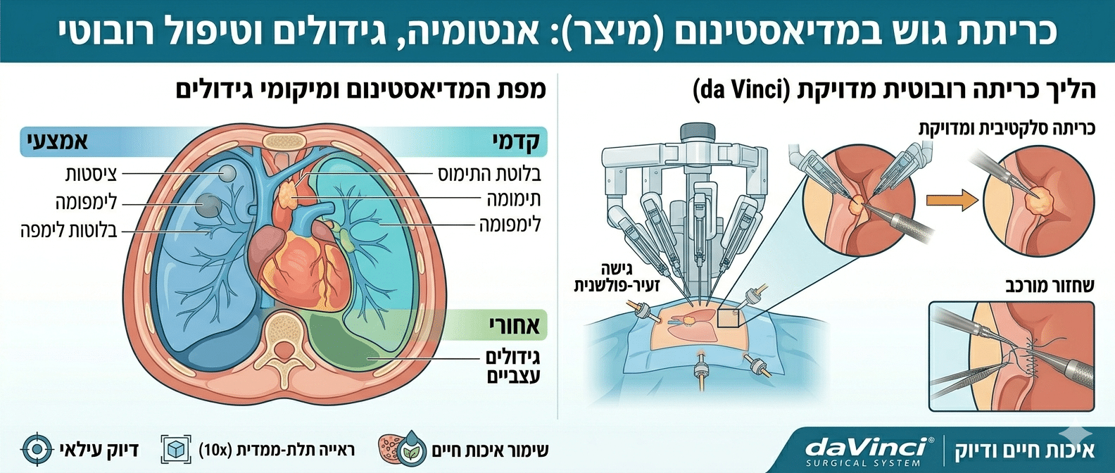 אינפוגרפיקה רפואית המפרטת את חלל המדיאסטינום (המיצר); חלוקה אנטומית למדורים (קדמי, אמצעי, אחורי) עם גידולים שכיחים כגון תימומה בלוטת התימוס, ציסטות וגידולים עצביים. בצד מודגמת גישה כירורגית זעיר-פולשנית עם זרוע רובוטית המבצעת כריתה סלקטיבית בדיוק גבוה.