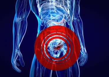 ניתוח סרטן פי הטבעת (Anal Cancer): כריתה בטנית-פרינאלית רובוטית (APR)