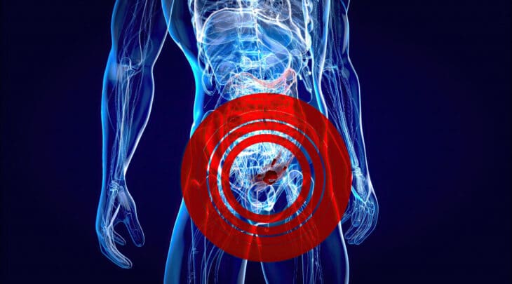 ניתוח סרטן פי הטבעת (Anal Cancer): כריתה בטנית-פרינאלית רובוטית (APR)