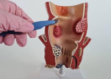 סרטן רקטום (Rectal Cancer): כריתת רקטום קדמית נמוכה (LAR) רובוטית