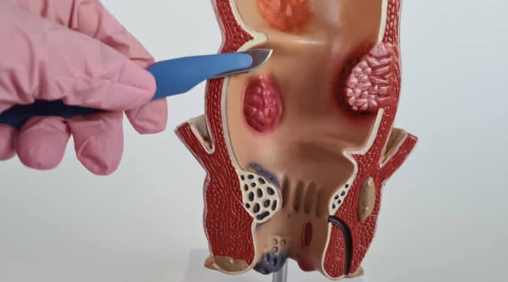 סרטן רקטום (Rectal Cancer): כריתת רקטום קדמית נמוכה (LAR) רובוטית