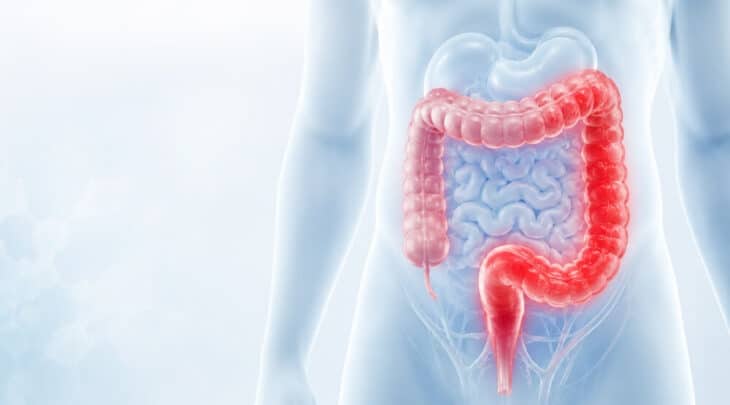 קוליטיס כיבית (Ulcerative Colitis): אילוסטרציה של דרכי המעי הגס